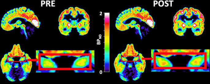 brain scans